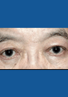 Results after Eyelid Lift  in United States of America and UK Patients at TransEarth Medical Tourism